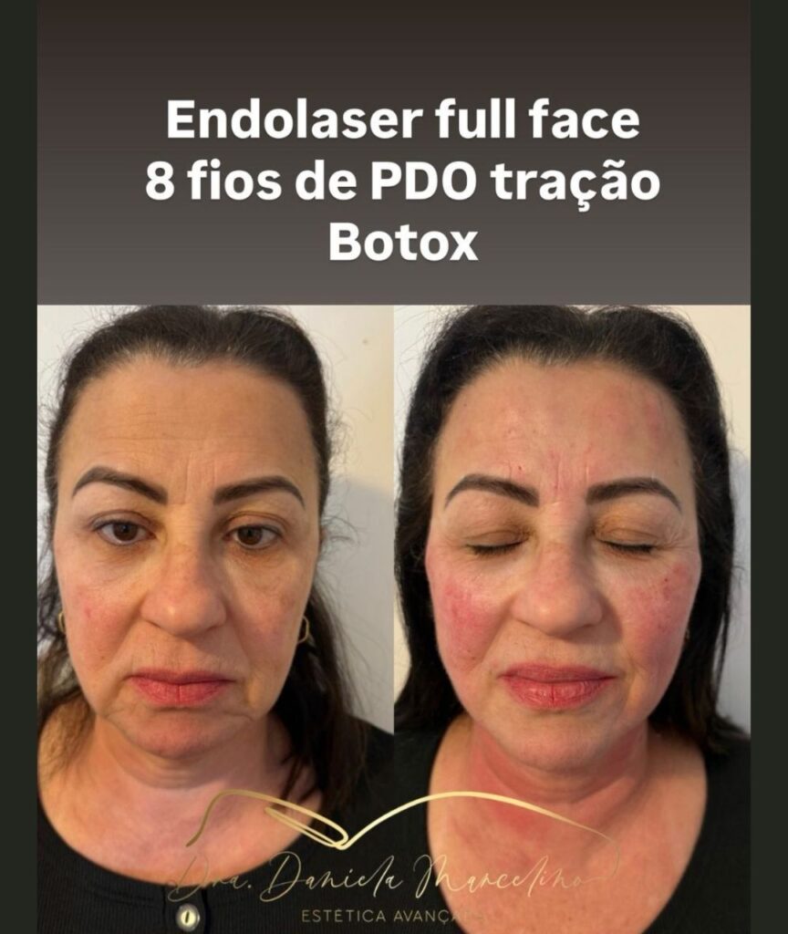 bioestimuladores (2)
