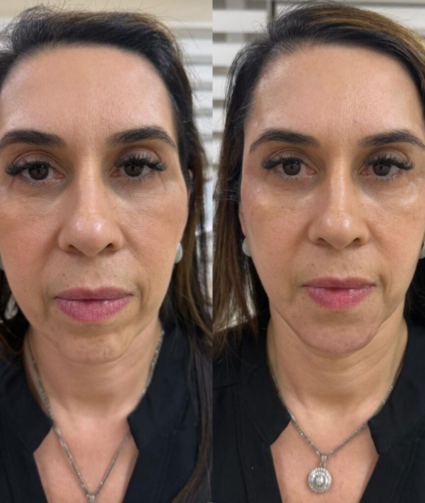 bioestimuladores (5)