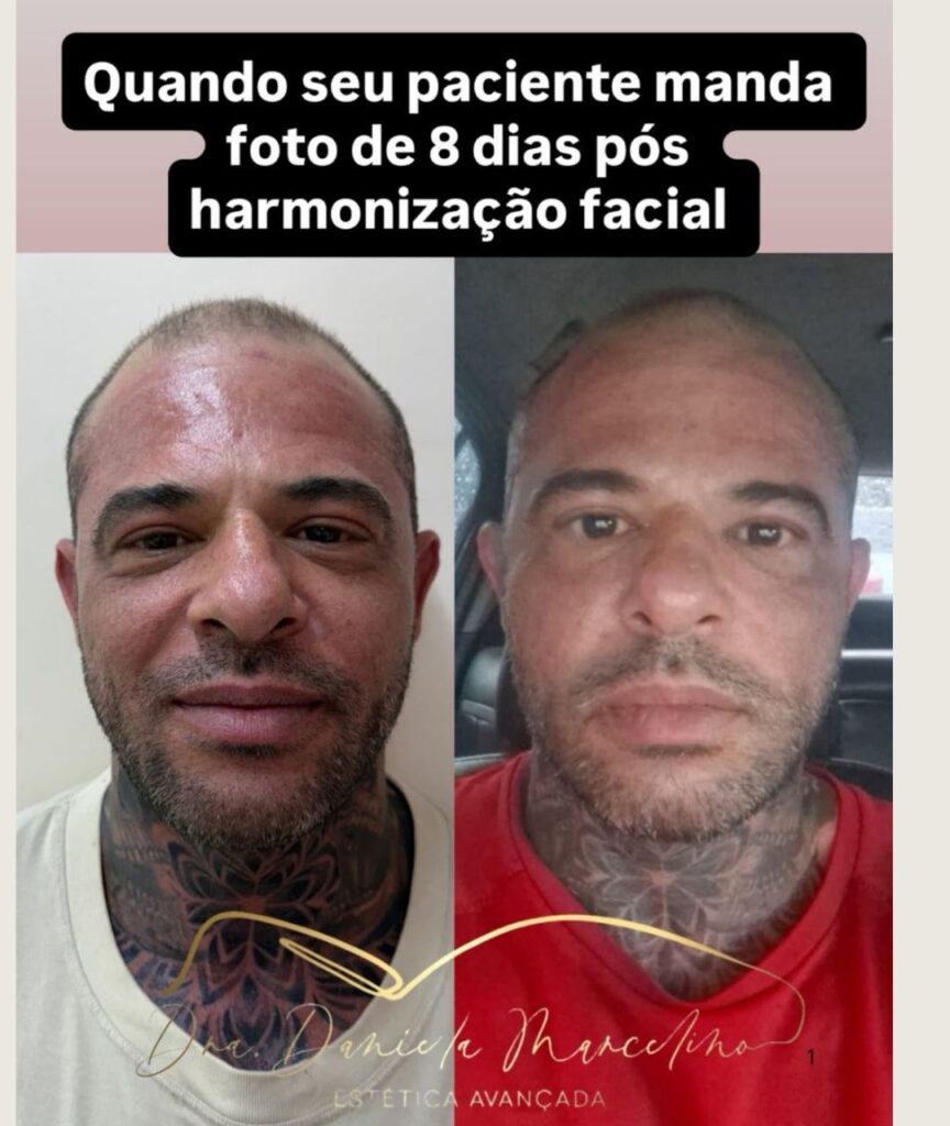 bioestimuladores (7)