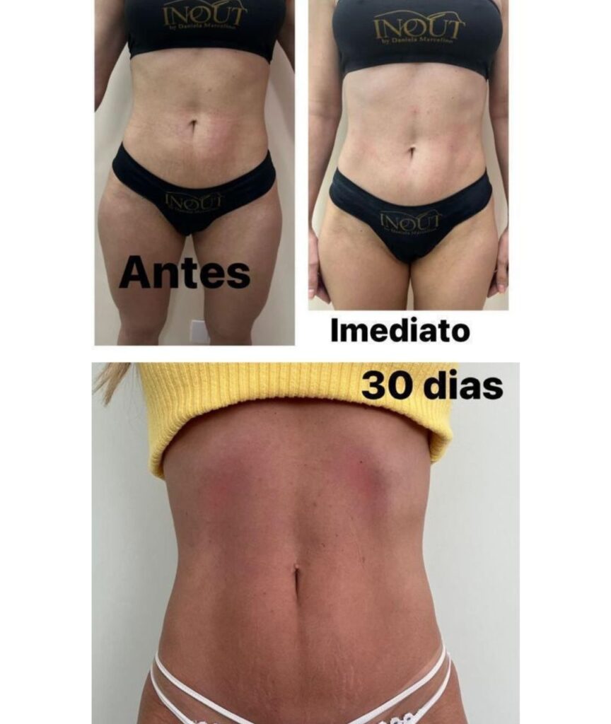 endolaser (13)