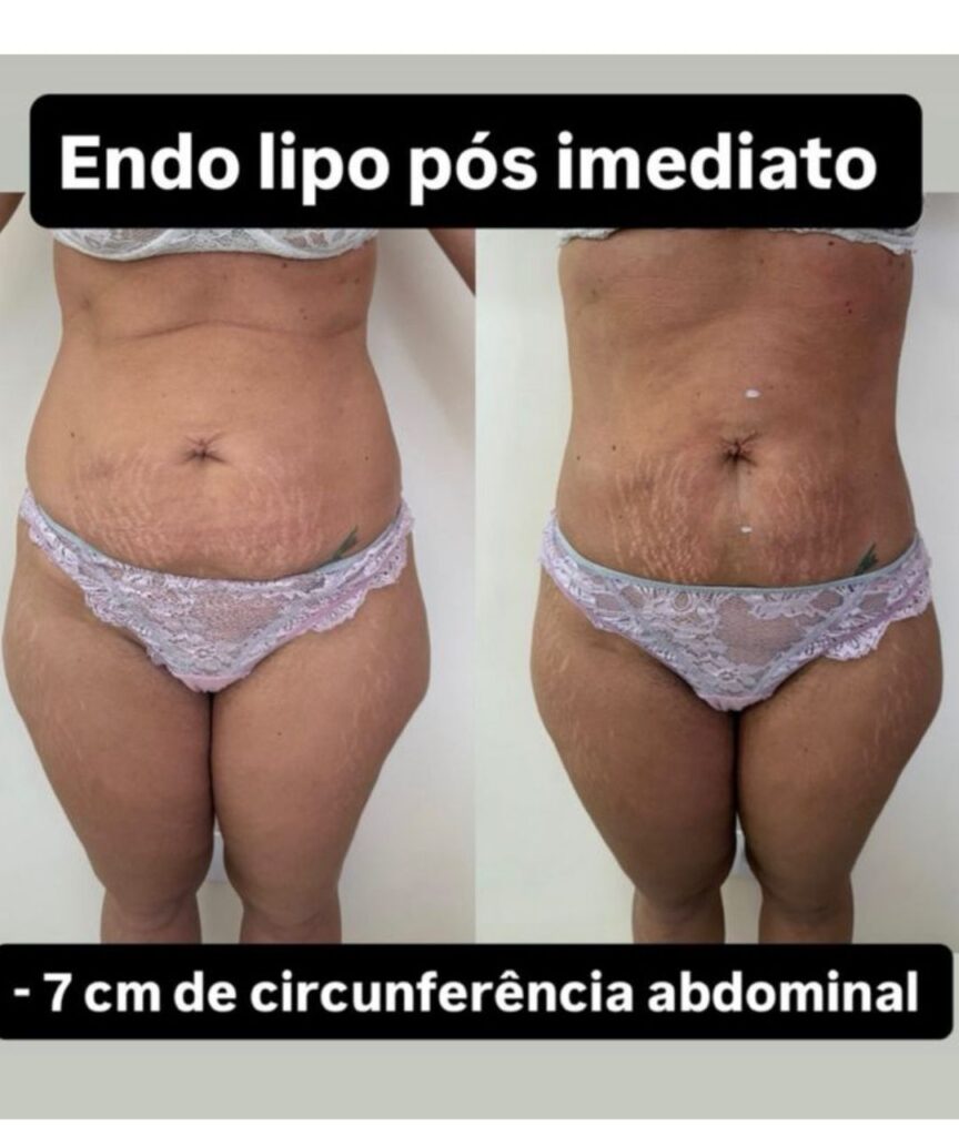 endolaser (2)