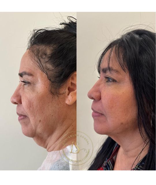endolaser facial (1)