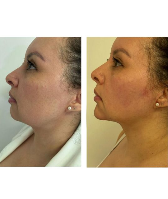endolaser facial (10)