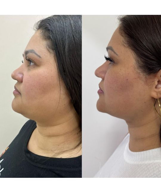 endolaser facial (11)