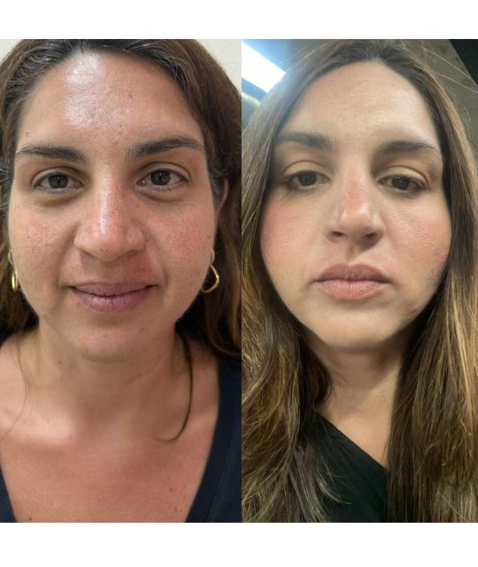 endolaser facial (12)