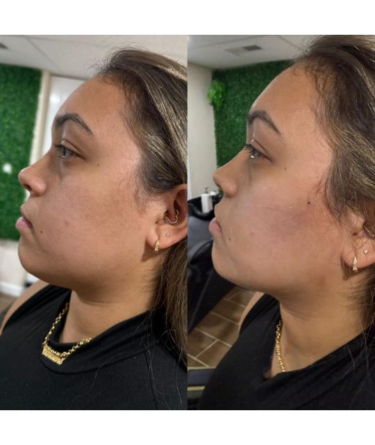 endolaser facial (13)