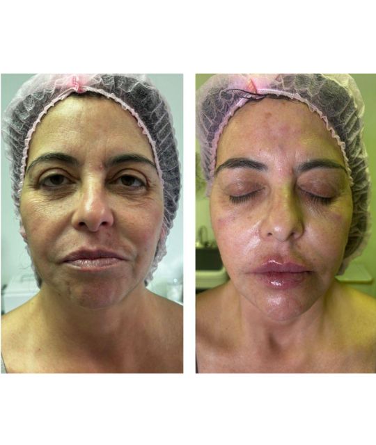 endolaser facial (14)