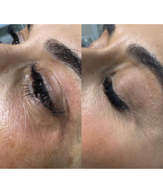 endolaser facial (15)