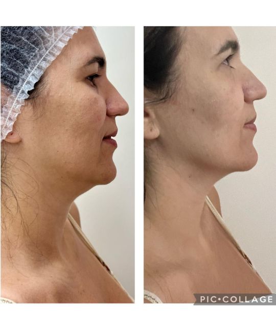 endolaser facial (2)