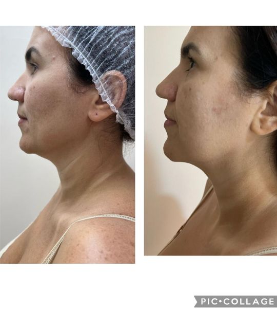 endolaser facial (3)