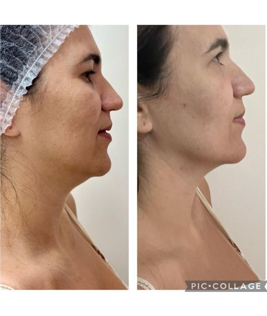 endolaser facial (4)