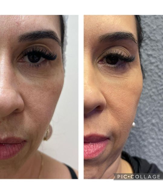 endolaser facial (5)