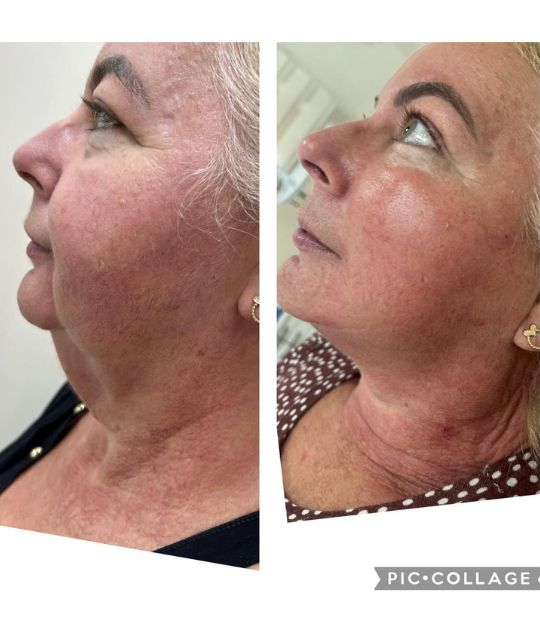 endolaser facial (6)
