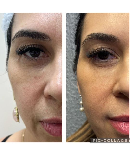 endolaser facial (7)