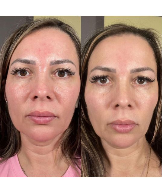 endolaser facial (8)