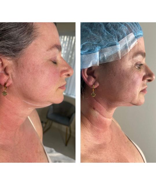 endolaser facial (9)