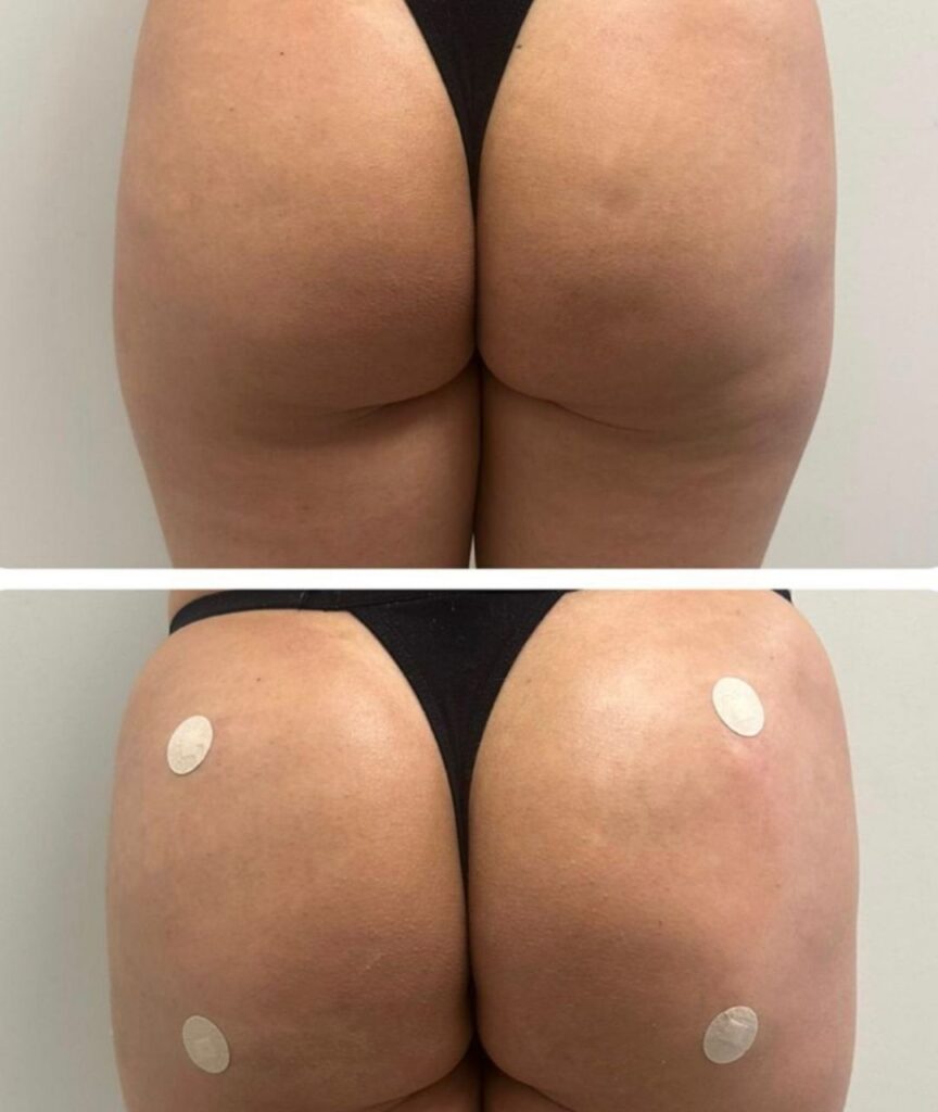 gluteo (1)