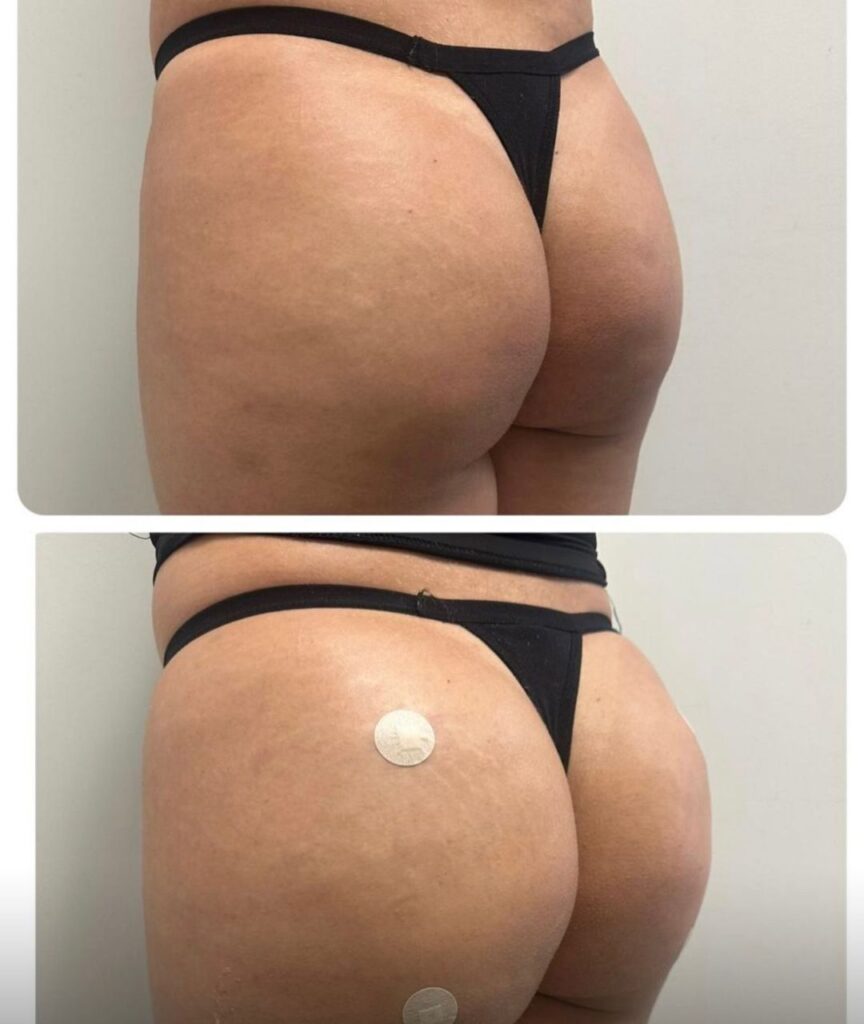 gluteo (10)