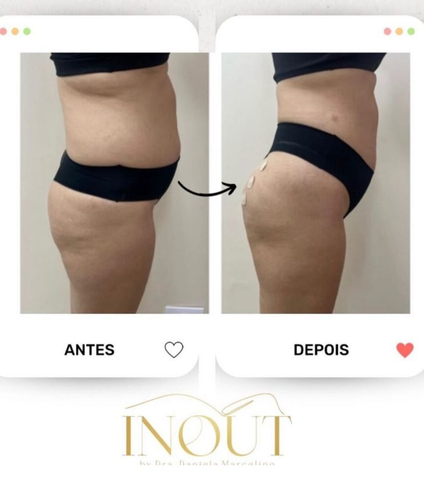 gluteo (2)