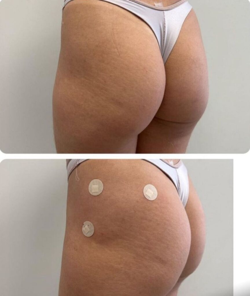 gluteo (3)