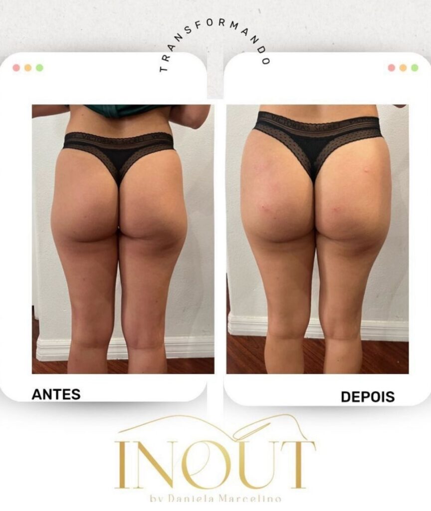 gluteo (4)
