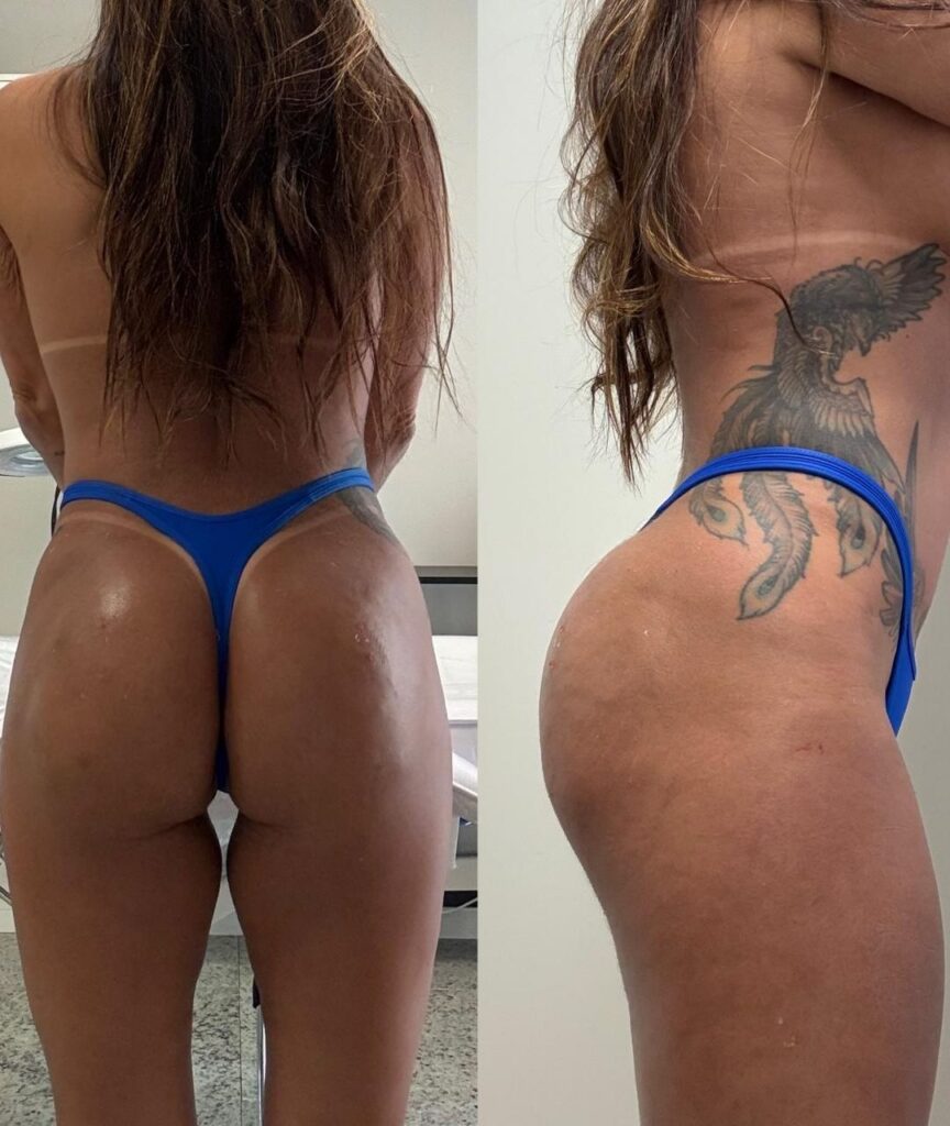 gluteo (5)