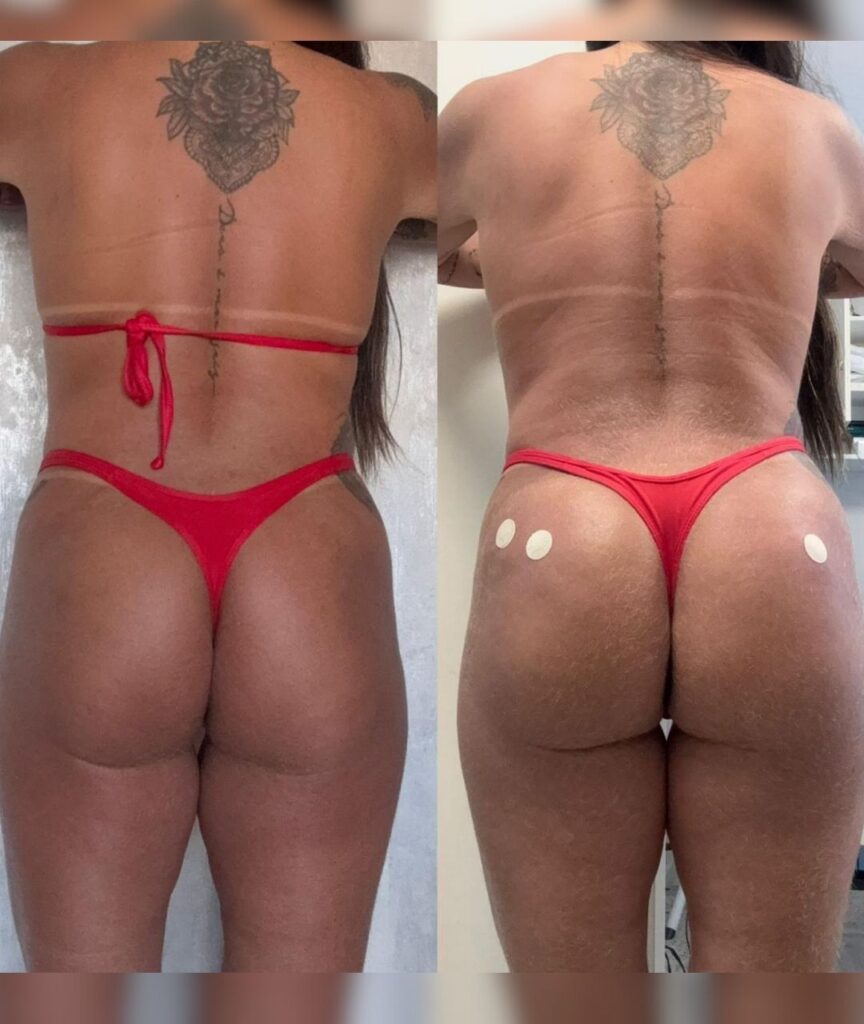 gluteo (6)