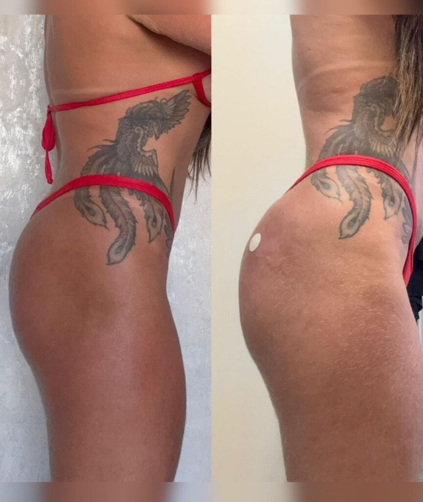gluteo (8)
