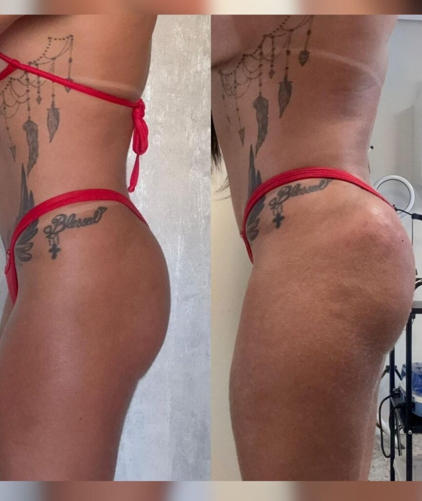 gluteo (9)