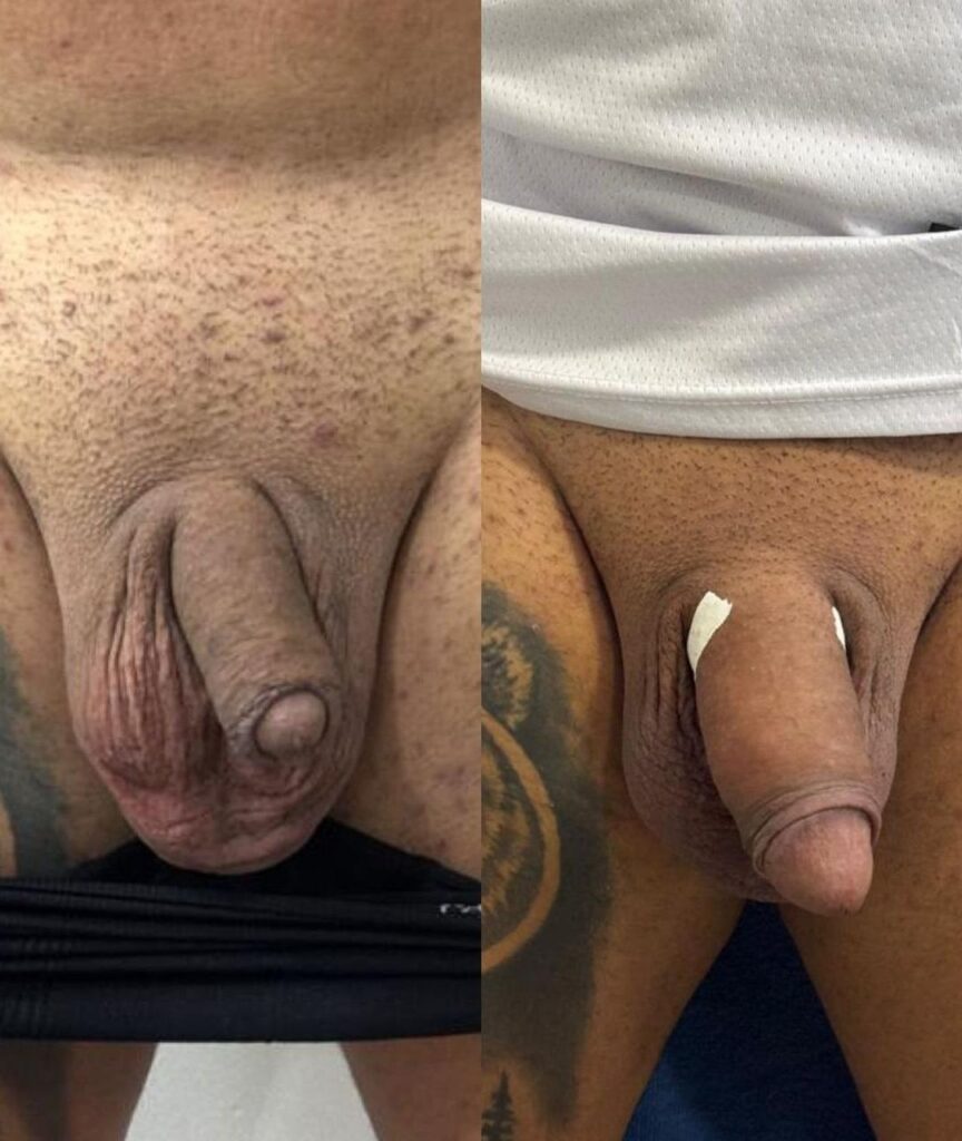 harmonizacao intima masculina (11)