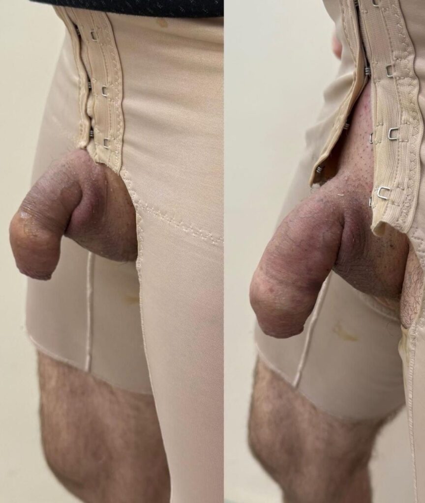 harmonizacao intima masculina (2)