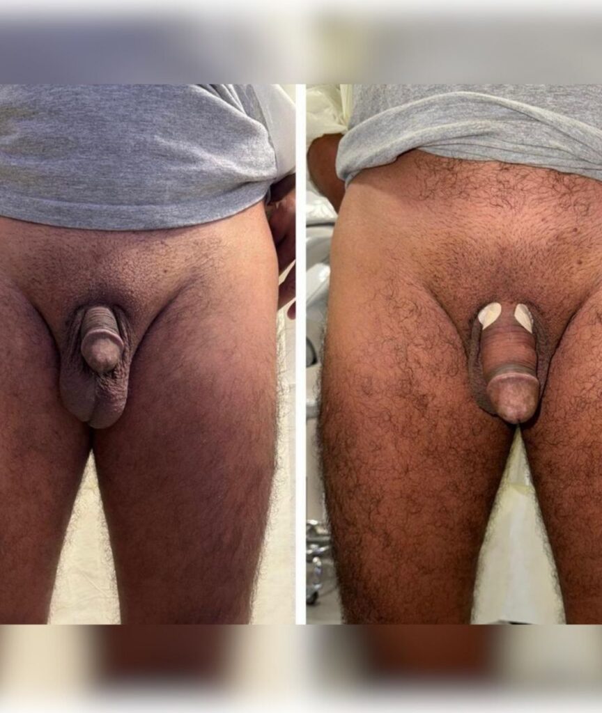 harmonizacao intima masculina (6)