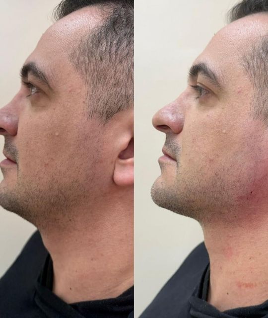 Botox (1)