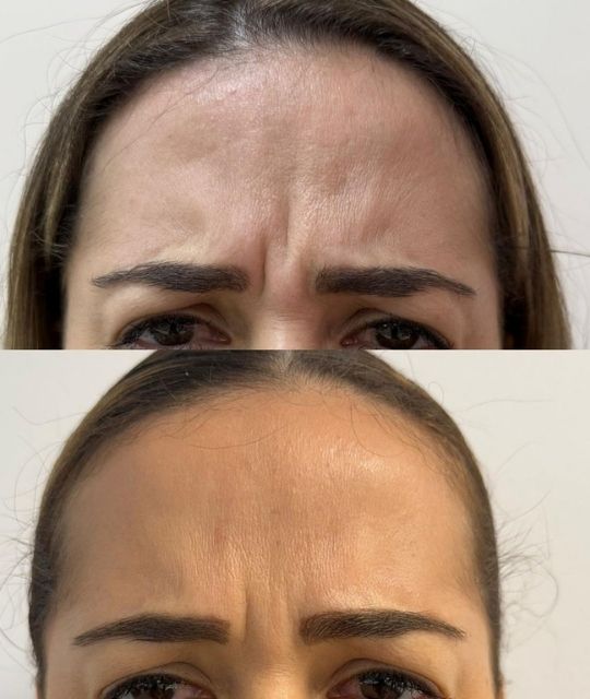 Botox (2)