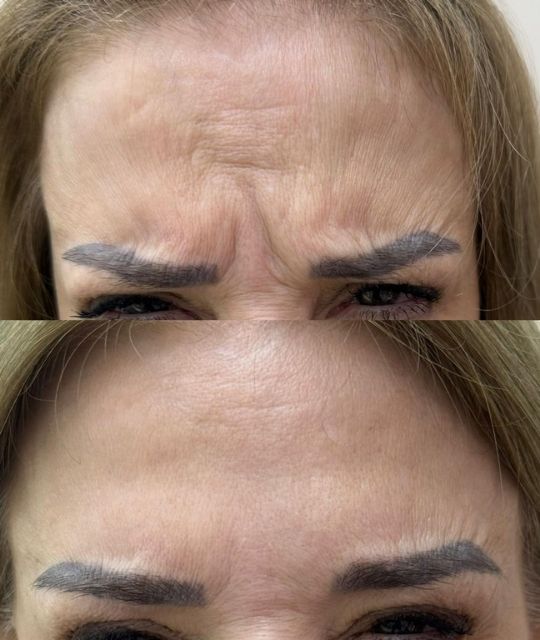 Botox (3)