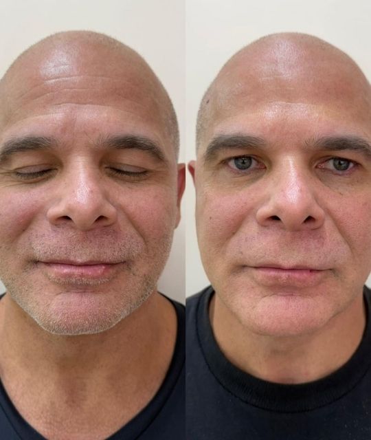 Botox (4)