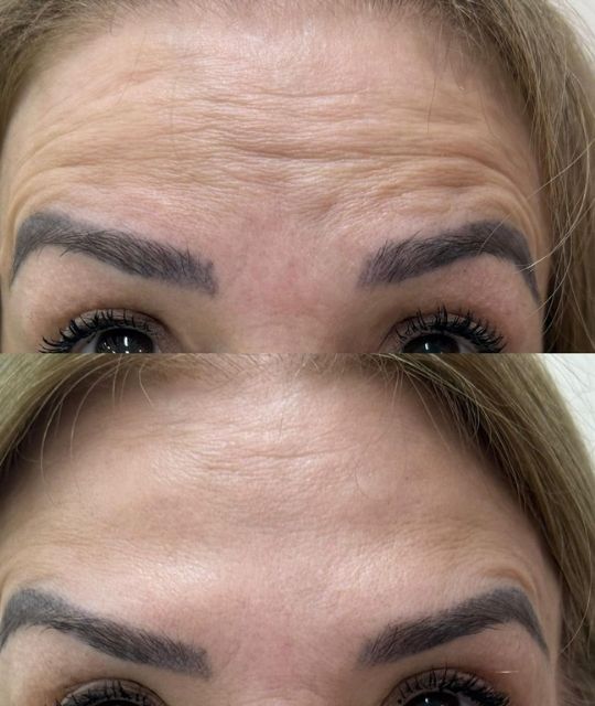 Botox (5)