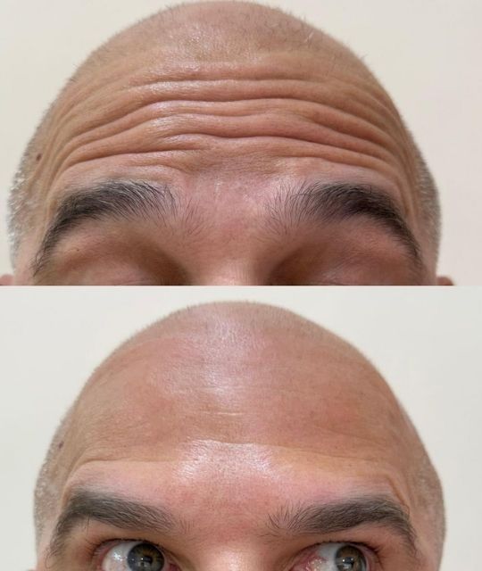 Botox (6)