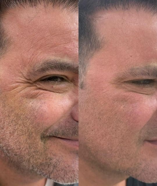Botox (7)