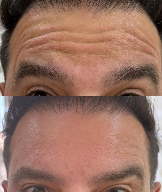 Botox (8)