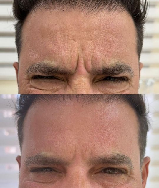 Botox (9)